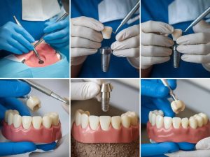 les étapes de la pose d'un implant dentaire : à quoi s'attendre ?
